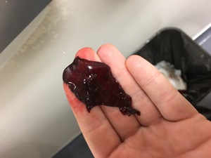Сгустки Крови После Секса
