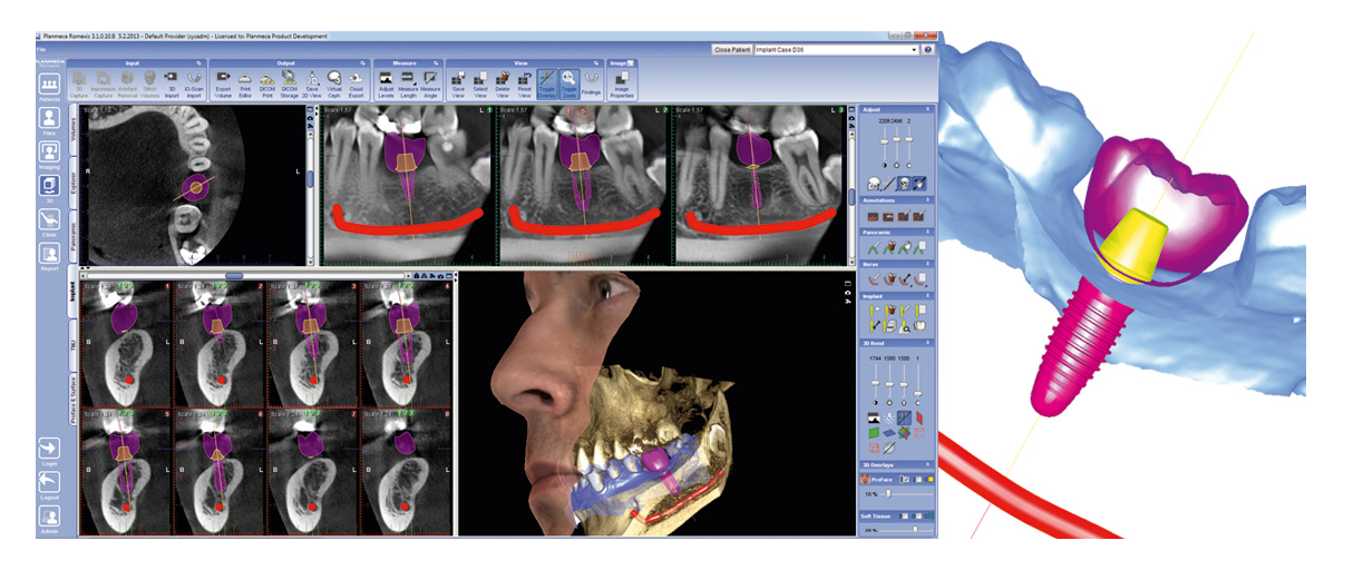 Применение 3D томографии в стоматологии