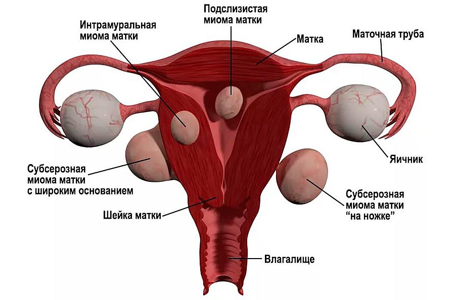 Удаление миомы матки: разнообразные методы и их сравнение