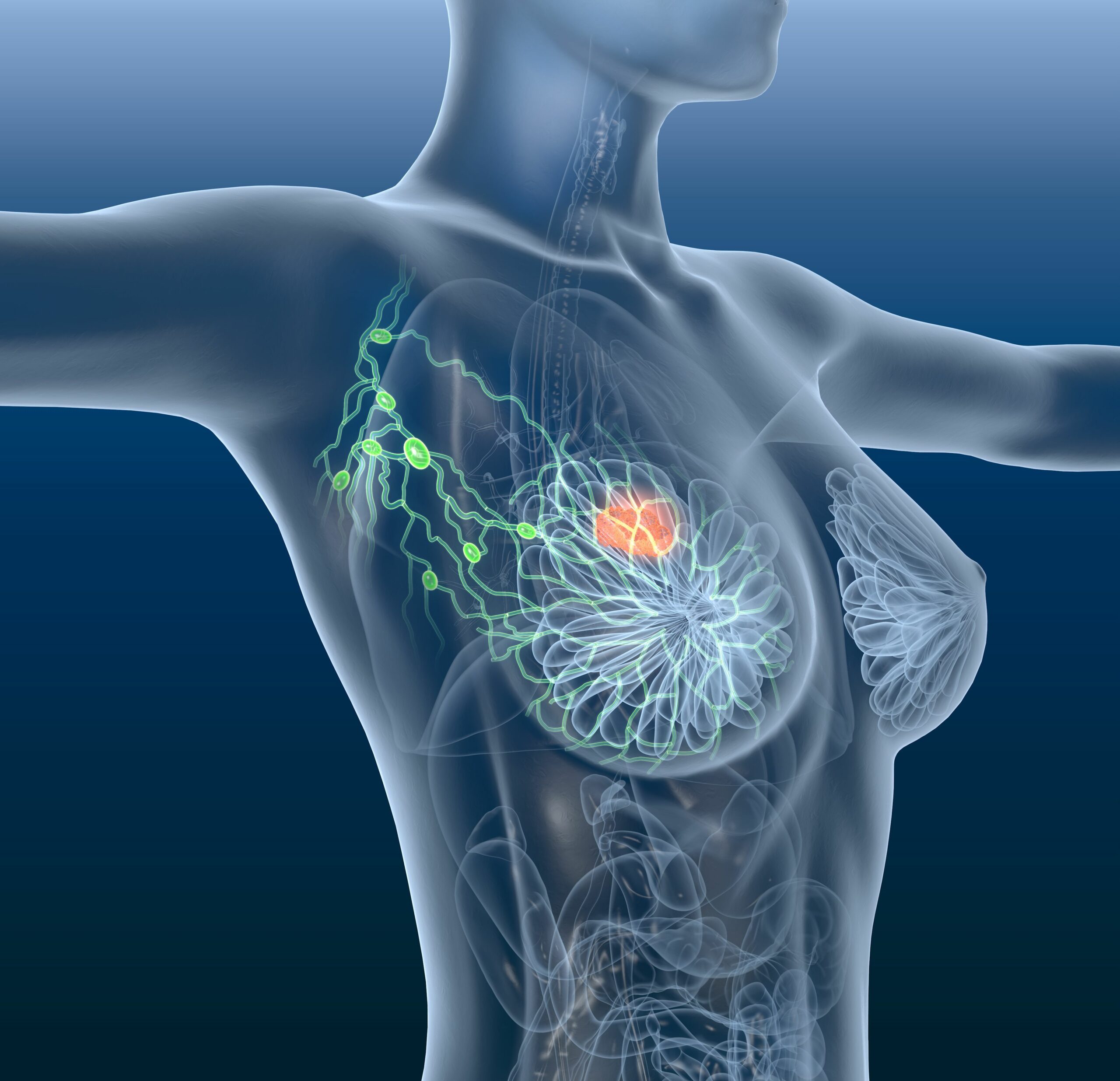 Рак молочной железы: почему важно знать об этой опасной болезни
